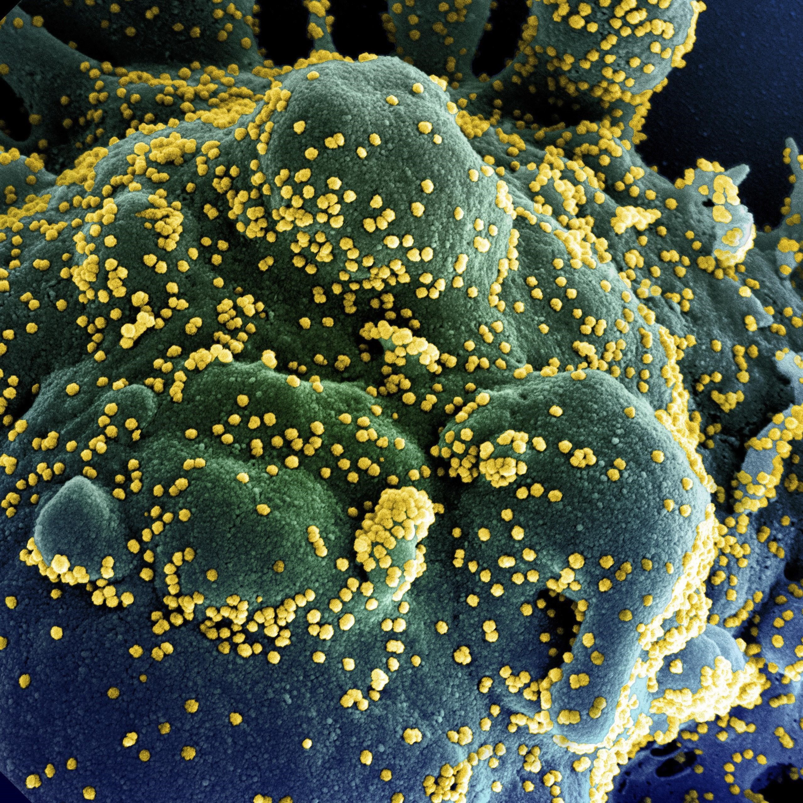 Hình ảnh quét qua kính hiển vi điện tử cho thấy một tế bào (màu xanh) bị virus SARS-COV-2 (màu vàng) xâm nhập, lấy từ mẫu bệnh phẩm của bệnh nhân COVID-19 tại Viện Nghiên cứu Dị ứng và Bệnh Truyền nhiễm Quốc gia, Fort Detrick, Maryland, Mỹ ngày 15/7/2020. (Ảnh: AFP/TTXVN)